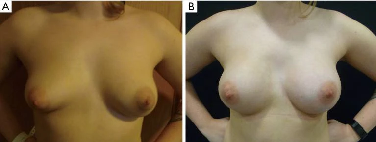 (L-R) *Breast augmentation*, Pre-op photo of breast augmentation; Post-op photo of breast augmentation: differential augmentation was undertaken to deal with pre-existing asymmetry, PubMed Central/GS, 2021.